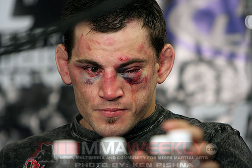 Koscheck Orbital Bone